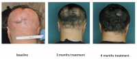 Three images of the stages of treatment with ruxolitinib. Baseline, 3 months, and 4 months